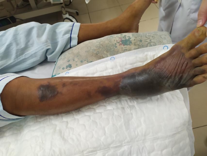 Hình ảnh nốt phỏng nước tím đen ở chân phải bệnh nhân lúc nhập viện.