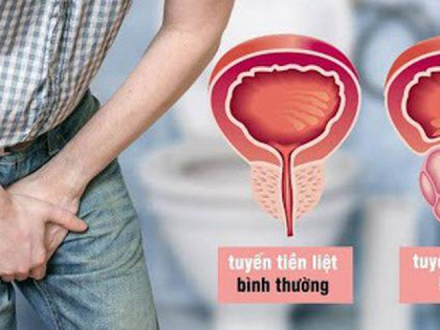 4 thói quen tăng nguy cơ gây ung thư tuyến tiền liệt, nam giới tuyệt đối không được bỏ qua