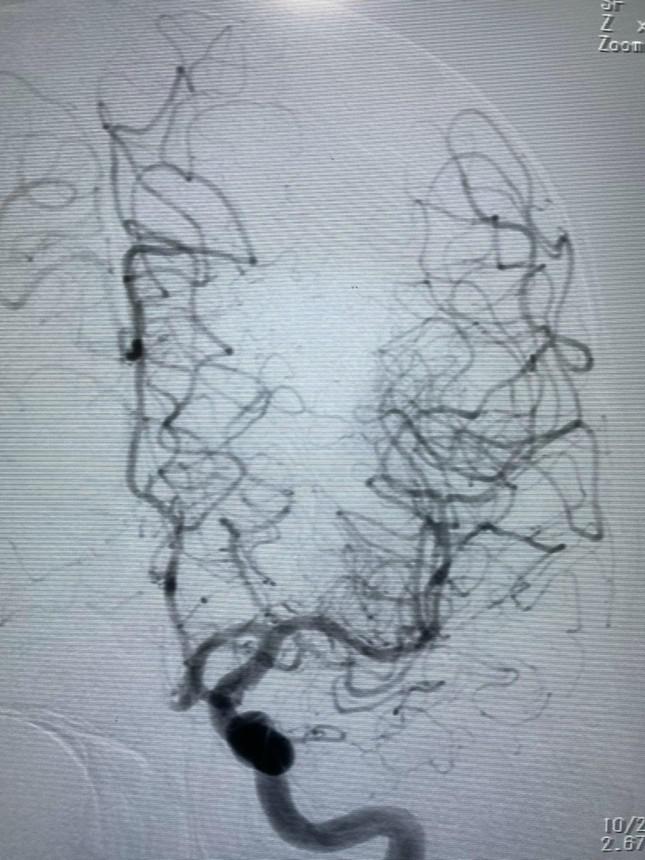 Mạch máu não của bệnh nhân sau khi được bác sĩ can thiệp tái thông