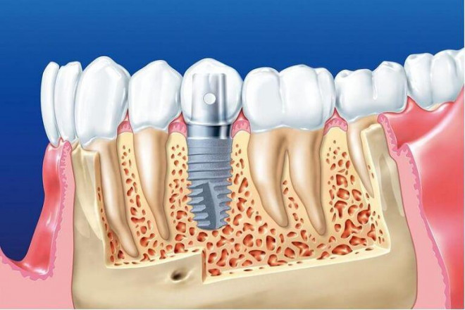 Lịch sử ra đời và phát triển của những chiếc răng giả - 2