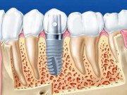 Sức khỏe đời sống - Lịch sử ra đời và phát triển của những chiếc răng giả