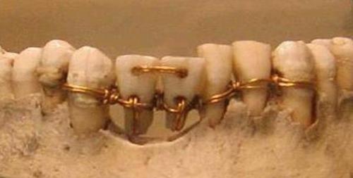 Kỹ thuật làm răng trên một xác ướp 4.000 năm tuổi. Hai chiếc ở giữa là răng của người khác. Ảnh: Ancient Origins.