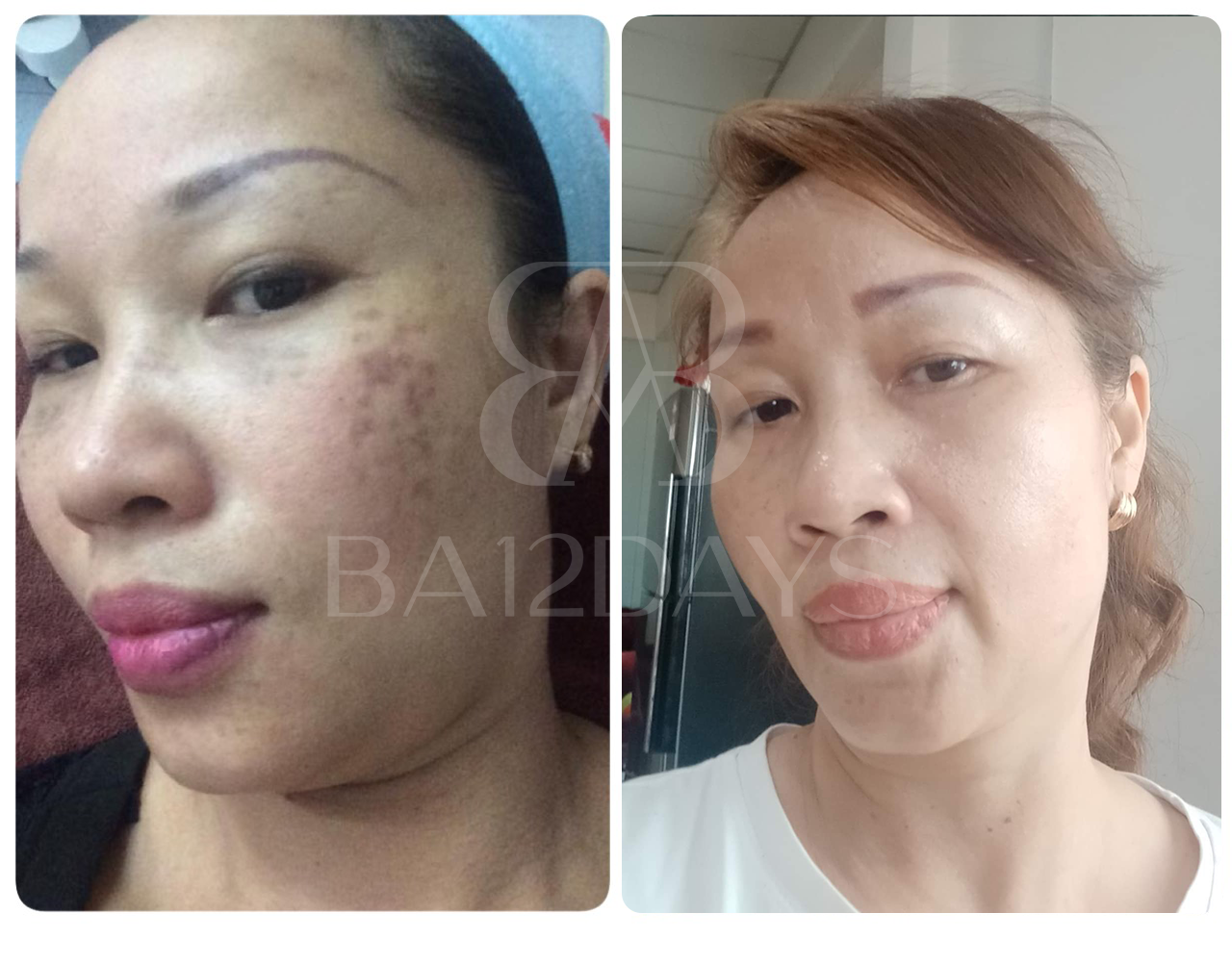 Kem ức chế nám Melasma Cream Ba12days phát huy hiệu quả sau bao lâu? - 2