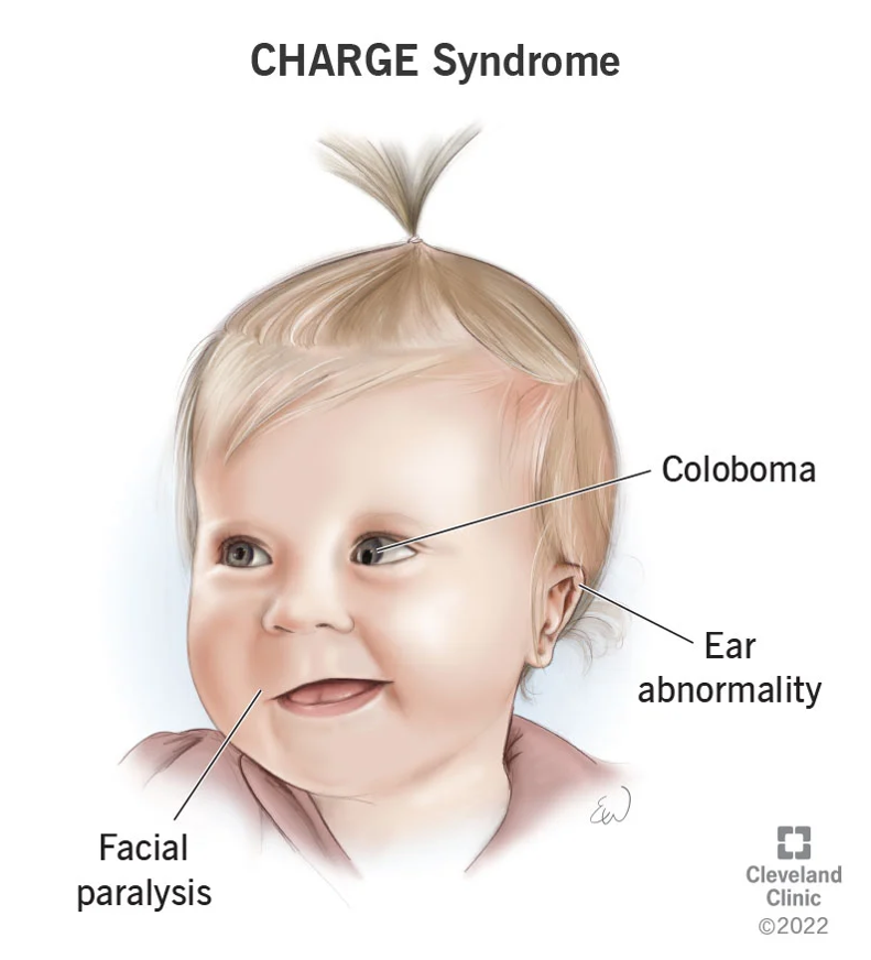 Hội chứng CHARGE là một tình trạng di truyền gây ra những thay đổi đối với mắt, tai và khuôn mặt của trẻ