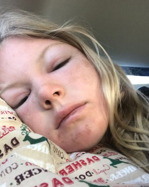 Cô gái bị cháy nắng kinh hoàng khiến gương mặt bị biến dạng như “người ngoài hành tinh” - 2