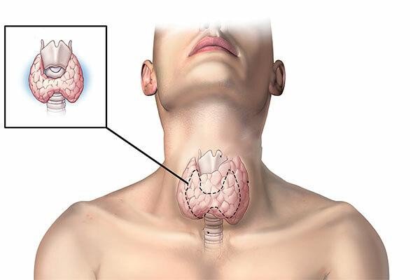 Dấu hiệu bất thường cảnh báo nguy cơ bị ung thư tuyến giáp, tuyệt đối không được bỏ qua - 1