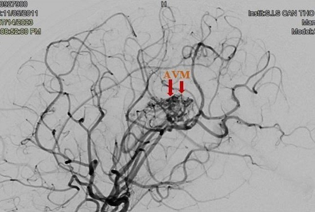 Túi giả phình mạch máu não của bệnh nhân trên hình ảnh kiểm tra