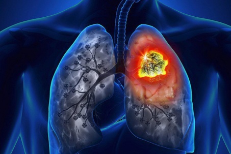 Vì sao nhiều người mắc ung thư phổi thường được phát hiện muộn?