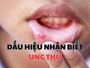 Sức khỏe đời sống - Dấu hiệu nào dễ nhận biết nhất mình có bị ung thư không?