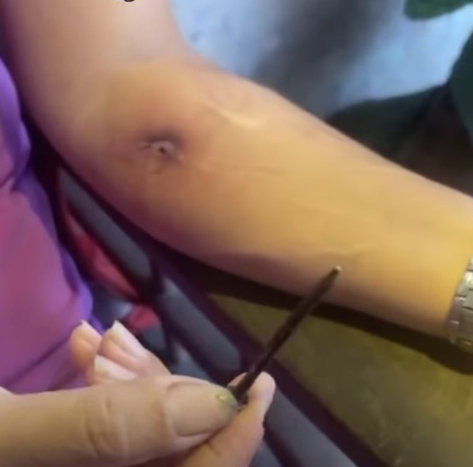 Thông tin một phụ nữ lấy 40 cây đinh từ vết thương trên cánh tay: Địa phương nắm tình hình - 2