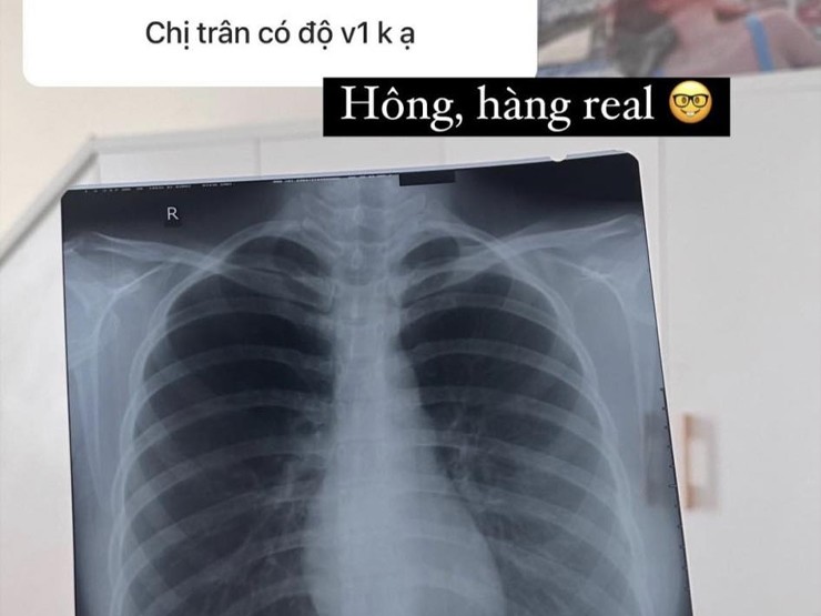 Ngọc Trân đăng tải hình ảnh chụp X-quang, chứng minh có vòng 1 đẹp tự nhiên.