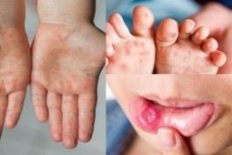 Dịch tay chân miệng bùng phát, xuất hiện chủng virus dễ gây bệnh nặng