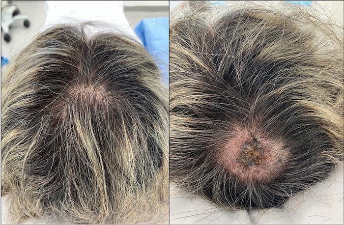 8 dấu hiệu ít người biết trên da đầu về căn bệnh chết người - 1