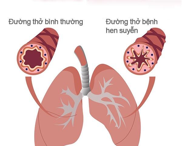 Suy hô hấp do tái phát hen suyễn, đàm ho, khó thở - nguy hiểm cần biết - 1