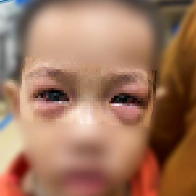 Hình ảnh trẻ bị đau mắt đỏ. Ảnh BVCC