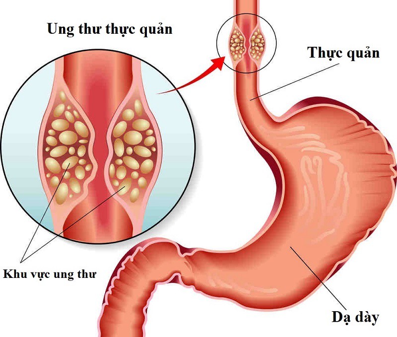 3 dấu hiệu cảnh báo ung thư thực quản: Dù mơ hồ người bị trào ngược cũng không nên bỏ qua! - 2