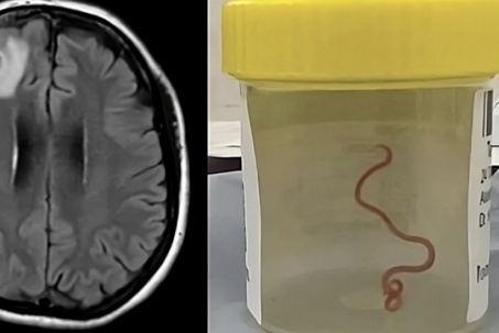 Bác sĩ sốc khi gắp ra sinh vật dài 8cm sống trong não người
