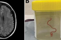 Ca mổ lấy giun sống khỏi não người đầu tiên trên thế giới