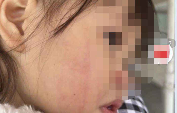 Hà Nội: Công an xác minh vụ bé gái 2 tuổi bị cô giáo đánh liên tiếp vào mặt - 2