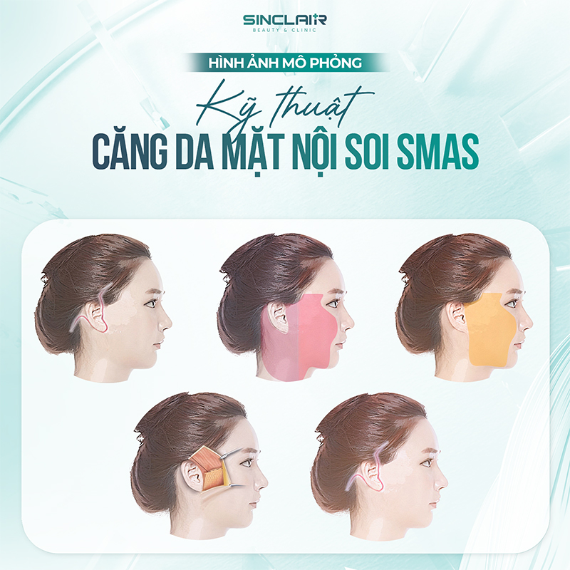 Phương pháp căng da mặt nội soi SMAS - Trẻ hóa gương mặt bền vững - 2