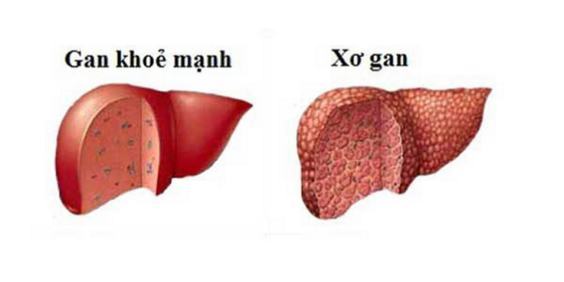 Lá vọng cách hỗ trợ trị bệnh gan - 1