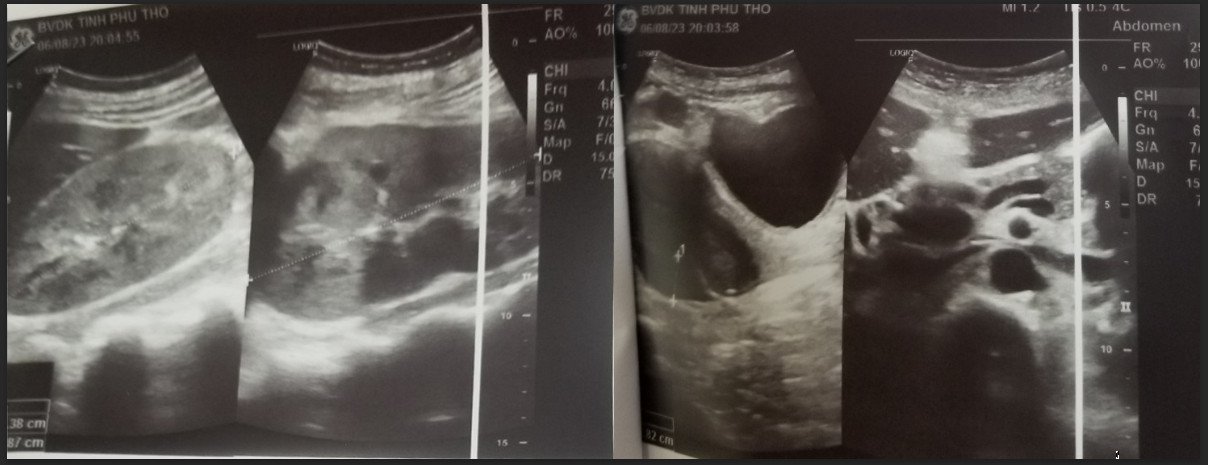 Hình ảnh siêu âm ruột thừa và thận của bệnh nhân trước và sau khi điều trị.