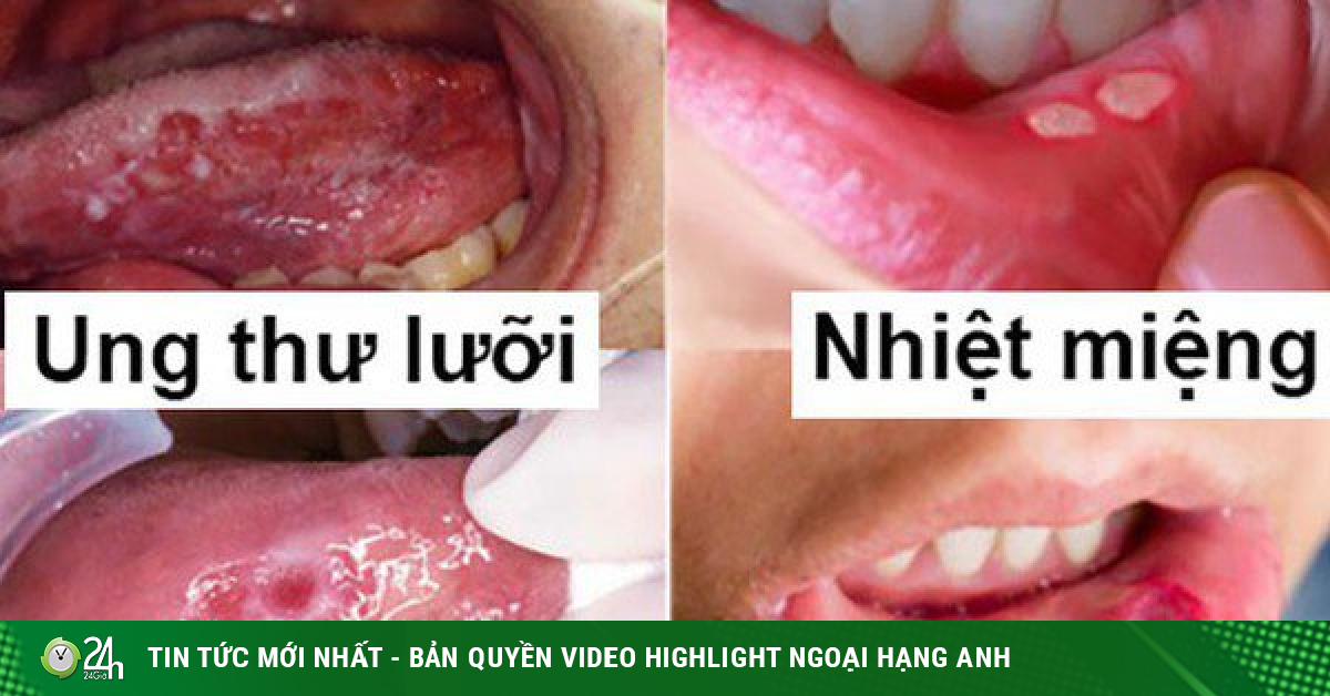 Bé 3 tuổi thoát 'án tử' sau 2 năm điều trị ung thư lưỡi, đây là những ...