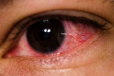 Bộ Y tế hướng dẫn cách xử trí khi bị đau mắt đỏ