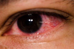 Bộ Y tế hướng dẫn cách xử trí khi bị đau mắt đỏ
