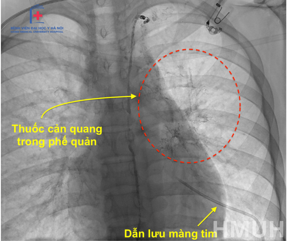 Đau ngực kèm khó thở, thanh niên 17 tuổi phát hiện bệnh hiếm gặp - 1