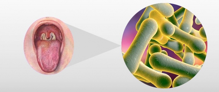 Bệnh bạch hầu là một bệnh nhiễm trùng nghiêm trọng do các chủng vi khuẩn có tên Corynebacteria diphtheriae gây ra.