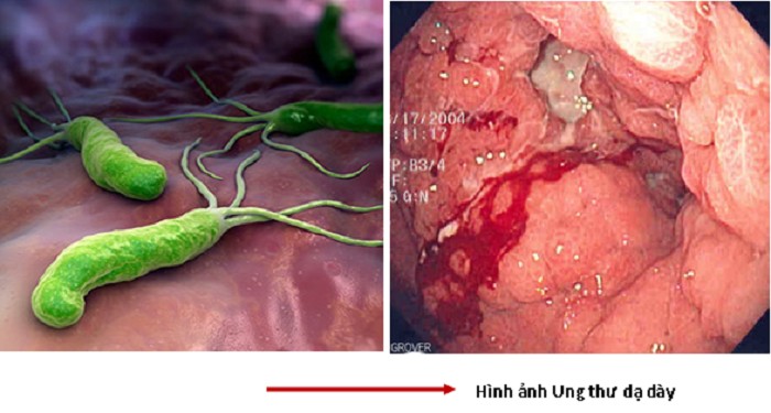 Vi khuẩn HP (Helicobacter pylori) được coi là một nguyên nhân gây ung thư dạ dày.