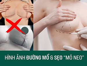 Giải cứu ngực sa trễ với phương pháp treo sa trễ không sẹo, an toàn cùng bác sĩ Đặng Thanh Tuấn - 2