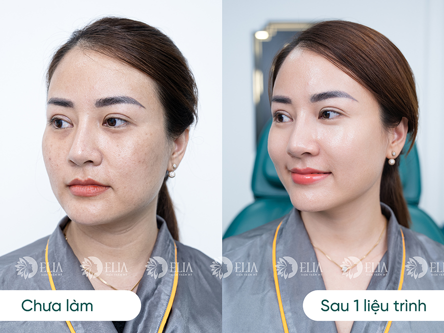 Kết quả da căng bóng mướt mịn sau 1 liệu trình cấy Meso Bio Young