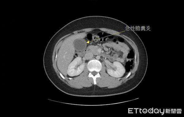 Nam sinh bị hoại tử túi mật nghiêm trọng vì món ăn rất nhiều người trẻ yêu thích - 2