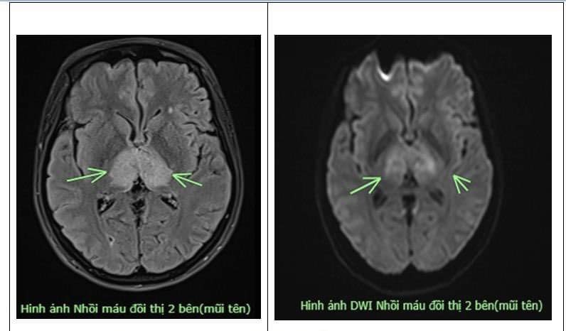 Phim chụp MRI não của bệnh nhân.