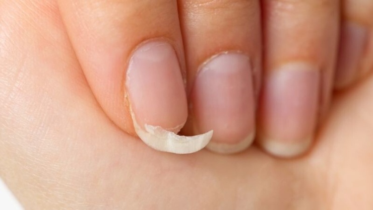 Móng tay là lớp sừng bảo vệ đầu ngón tay, nhưng nhiều người gặp tình trạng móng giòn, dễ bong tróc hoặc gãy