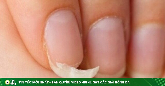 Móng tay giòn, dễ gãy là biểu hiện của những vấn đề sức khỏe không thể bỏ qua