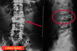 Tin tức sức khỏe - 5 thói quen tàn phá xương khớp cực nhanh, nên bỏ càng sớm càng tốt.