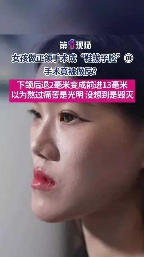 Thay vì thu hẹp 2 milimet, bác sĩ phẫu thuật khiến vùng hàm dưới của Xiaoyu đẩy ra trước 13 milimet.
