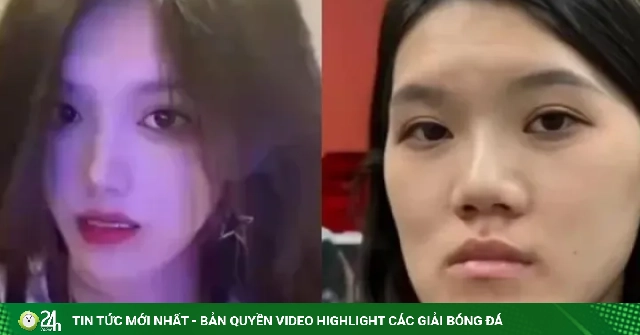 Người mẫu biến dạng mặt sau ca chỉnh hàm sai 13 milimet