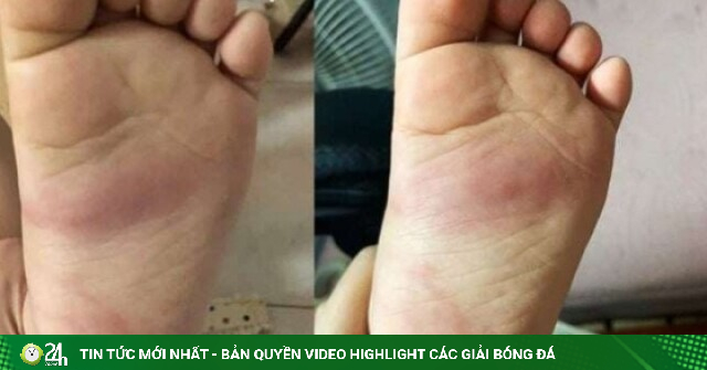 Hưng Yên: Xác minh phản ánh trẻ 3 tuổi bị bầm tím chân sau khi ở trường mầm non về