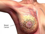 Sức khỏe đời sống - Đã là phụ nữ, bạn đừng quên 7 dấu hiệu ung thư vú