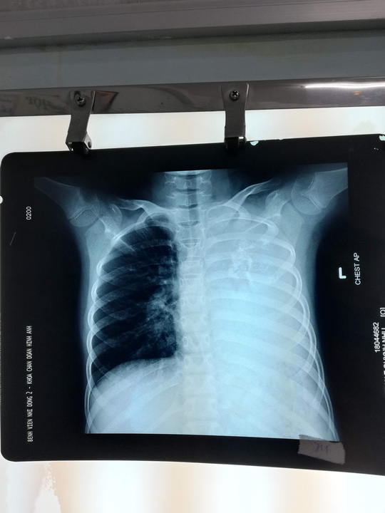 Cứu bé gái có khối u phổi khổng lồ nặng 1,5 kg - 1