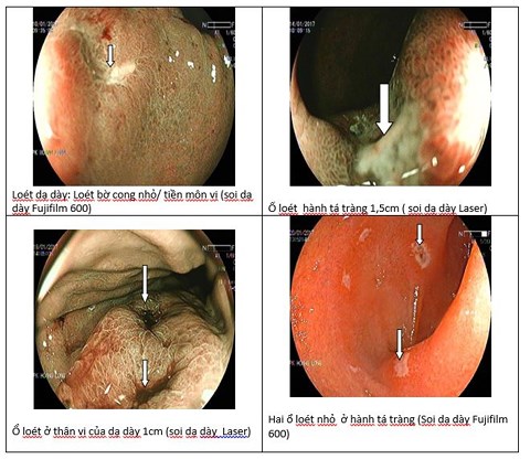 Thủ phạm khiến nhiều người trẻ bị viêm loét dạ dày - 1