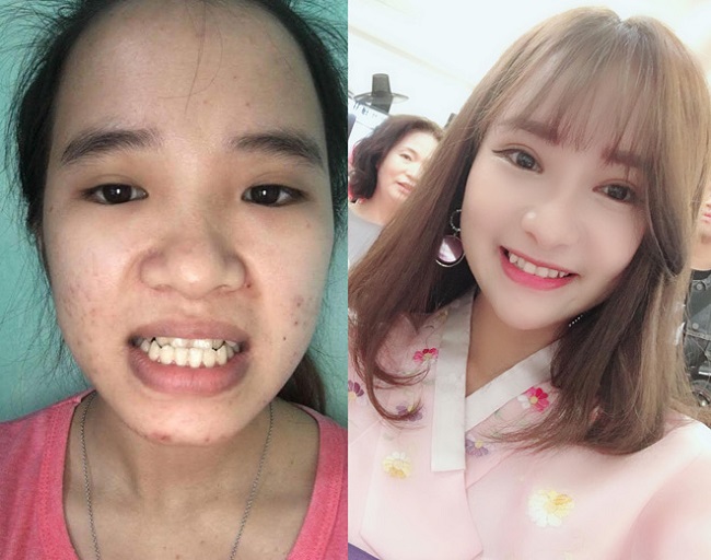 6. Nguyễn Thị Cẩm: Cô gái Quảng Nam 20 tuổi này gặp nhiều khó khăn trong ăn uống, sinh hoạt và cuộc sống chỉ vì hàm răng cắn ngược. 