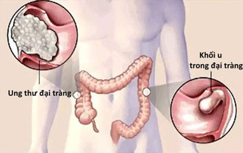 Những sự thật ít biết về ung thư đại trực tràng - 1
