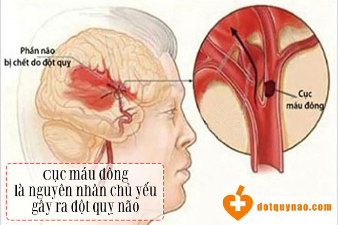 Nghiên cứu mới tiếp tục khẳng định vai trò của Nattospes với bệnh nhân nhồi máu não - 1