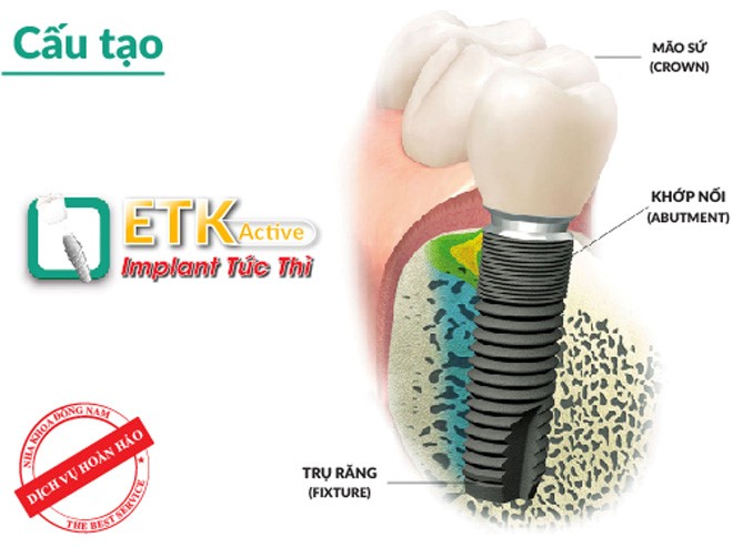ETK Active dẫn đầu chất lượng công nghệ Trồng Răng Implant - 1