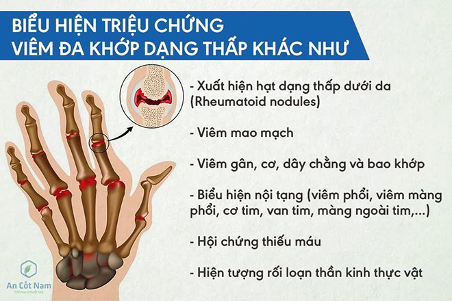 Viêm đa khớp dạng thấp là gì? Nguyên nhân và cách chữa trị bệnh - 3